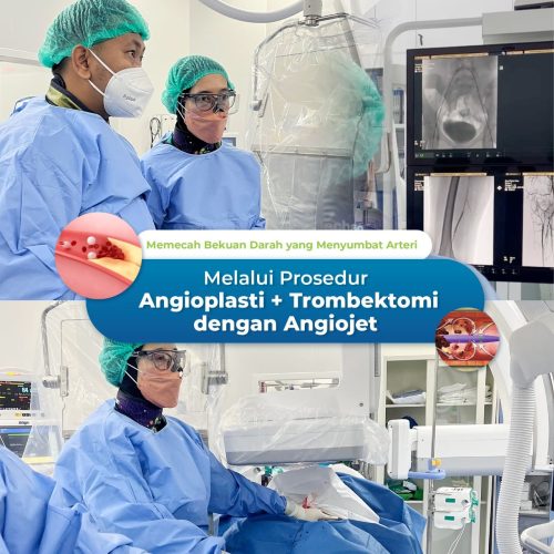RS PELNI - Trombektomi Angiojet
